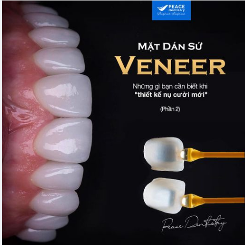 MẶT DÁN SỨ VENEER – NHỮNG GÌ BẠN NÊN BIẾT KHI QUYẾT ĐỊNH “THIẾT KẾ NỤ CƯỜI MỚI" ! (Phần 2)