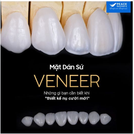 MẶT DÁN SỨ VENEER – NHỮNG GÌ BẠN NÊN BIẾT KHI QUYẾT ĐỊNH “THIẾT KẾ NỤ CƯỜI MỚI" ! (Phần 3)