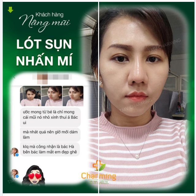 Mắt em nhấn mí xinh xinh, Mũi em lót sụn, chóp thu gọn gàng.Cười lên xao xuyến lòng chàng, Ai mang em đến cho chàng cưới luôn.