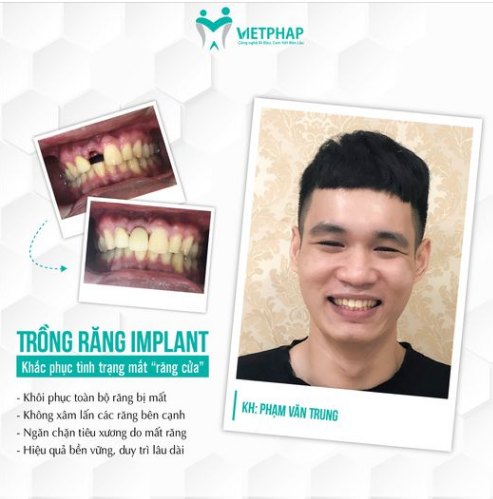 MẤT RĂNG CỬA - LÀM THẾ NÀO ĐỂ KHẮC PHỤC?