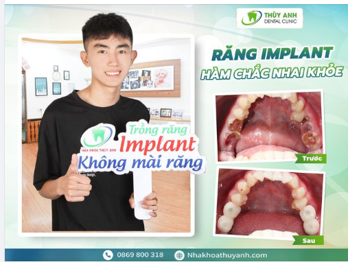 MẤT RĂNG SỚM TRẢI NGHIỆM KINH KHỦNG VỚI BẤT CỨ AI