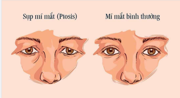 MẮT SỤP MÍ GIÀ NUA PHẢI LÀM SAO ???