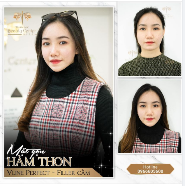 Mặt thon - Hàm gọn đẹp mềm mại, tự nhiên với Thon gọn hàm Vline Perfect - Filler Cằm