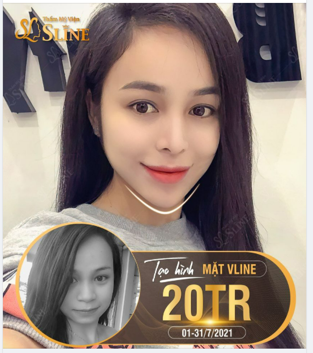 MẶT THON - HÀM GỌN VỚI TẠO HÌNH V-LINE