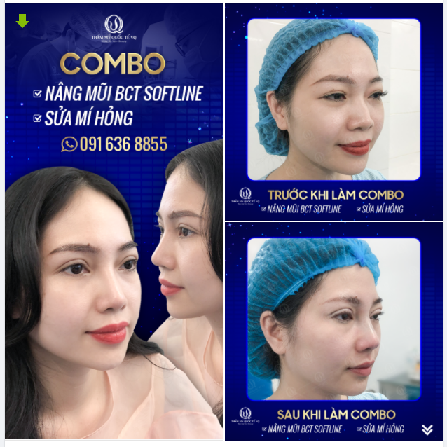 Mí bác sĩ Quang sửa, mũi Bác sĩ Quang nâng