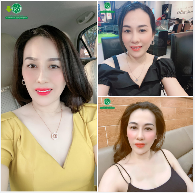 MÍ MẮT DUY TRÌ BỀN LÂU SAU NHIỀU NĂM THỰC HIỆN