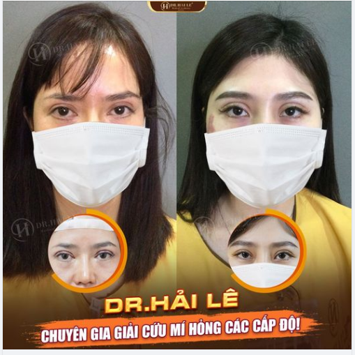 MÍ XẤU HỎNG TỚI ĐÂU - Dr.Hải Lê đều xử lý được với kỹ thuật SỬA MÍ  DEEP TECH.!!
