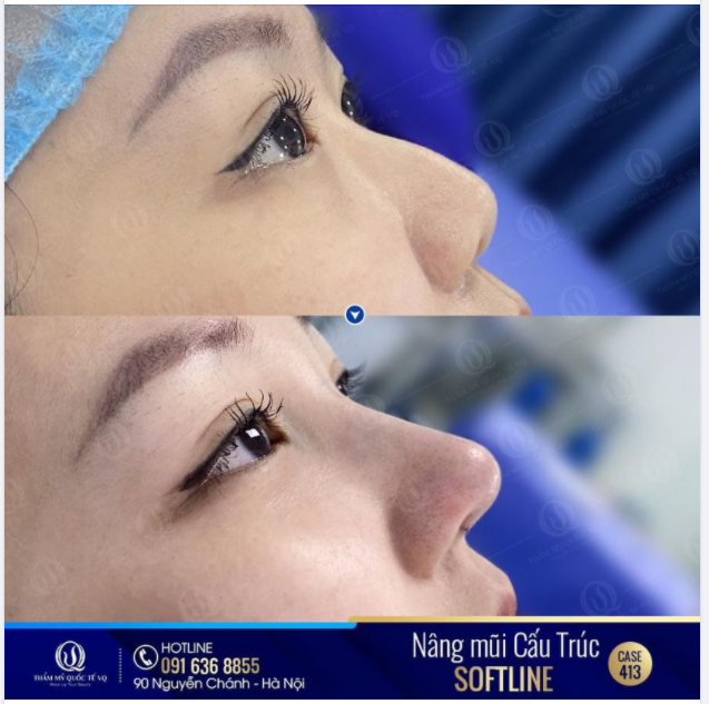 "Mình không tưởng tượng nổi mũi lại cao và đẹp được đến thế này " - KH chia sẻ