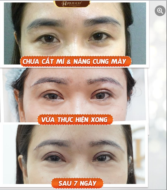 Mình muốn đôi mắt trẻ hơn chút, mắt sụp mí quá!