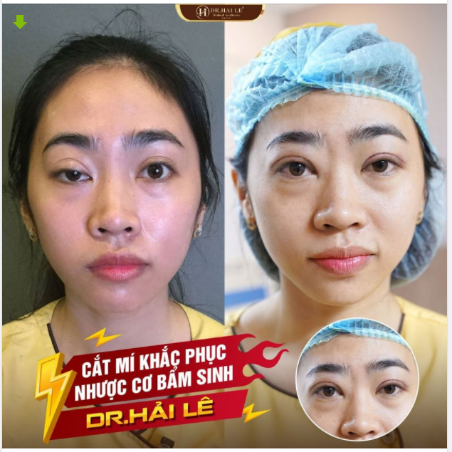 Mỗi ngày đều đặn Dr.Hải Lê vẫn nhận được những câu hỏi Sụp mí bẩm sinh có khắc phục được không?