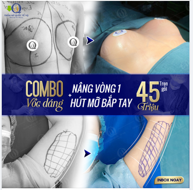​​​​​​​Một BẮP TAY TO kết hợp với V1 LÉP KẸP thì ...sẽ chẳng làm nên chuyện gì.