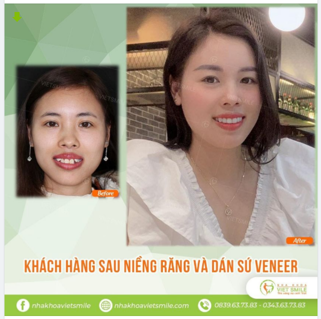 Một bức hình thay ngàn lời muốn nói, hãy cùng theo dõi sự thay đổi rõ rệt của khách hàng tại Việt Smile