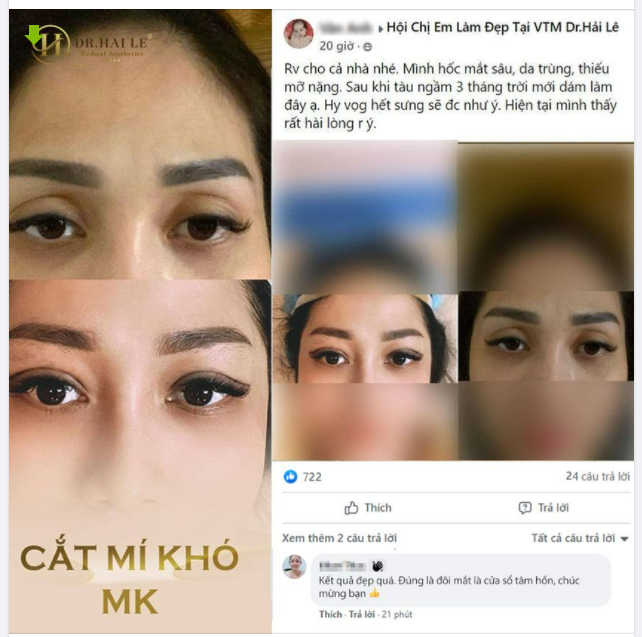MỘT CA CẮT MÍ SIÊU KHÓ ĐÃ ĐƯỢC "XỬ LÝ" HOÀN HẢO VỚI CẮT MÍ MK TẠI DR.HẢI LÊ.!!