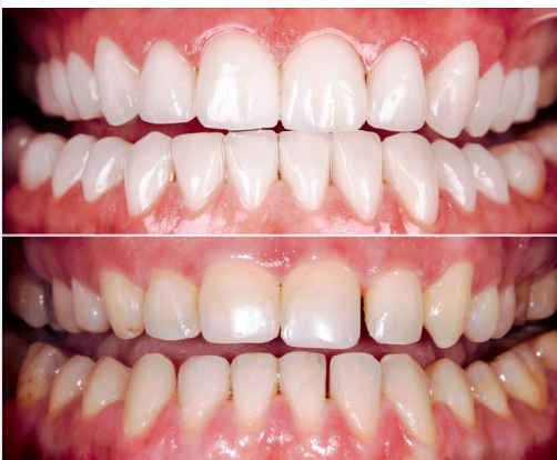 Một ca Veneer sứ EMAX làm theo kỹ thuật CAD/CAM, chính xác đến từng micromet