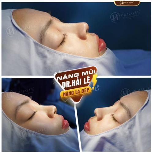 Một dáng mũi siêu đẹp ngay 60 phút nâng - Nhìn góc nào cũng phải thả triệu like -  thế này đây ạ