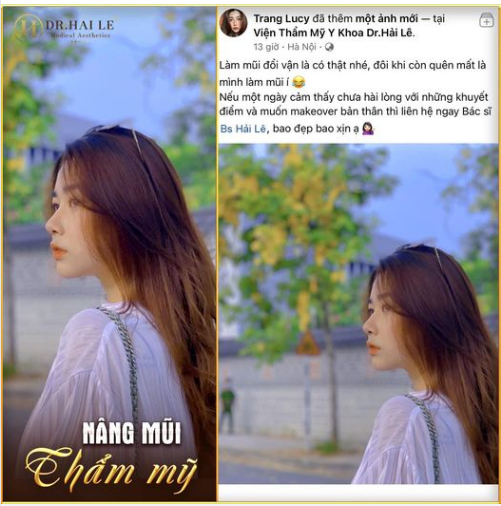 Một kết quả Nâng mũi Demi 5D cho chị khách hàng tại Dr.Hải Lê