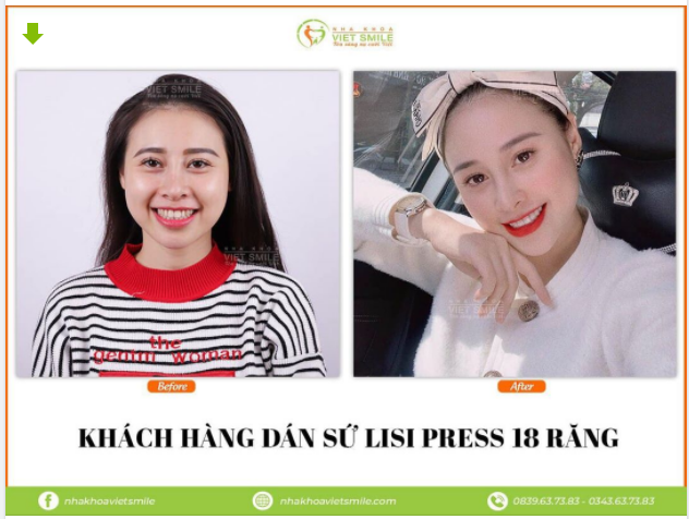 MỘT NỤ CƯỜI - HAI SẮC THÁI VỚI DÁN SỨ LISI PRESS