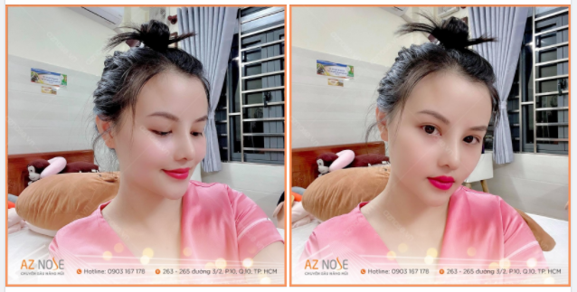 MŨI CẤU TRÚC, DÁNG TỰ NHIÊN SAU 1 THÁNG