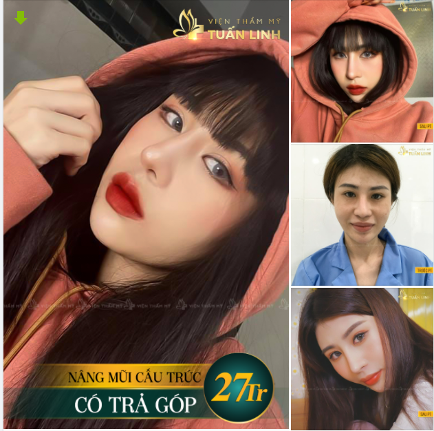 MŨI CẤU TRÚC SAU 2 NĂM ''ĐẸP XỈU''...!