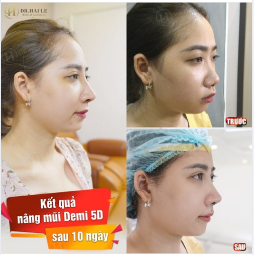 Mũi DEMI 5D sau 10 ngày vào form đẹp tự nhiên.!