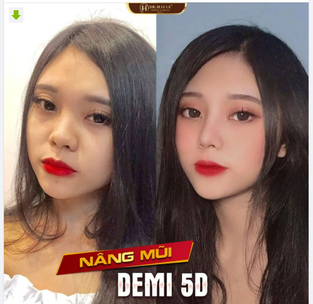 Mũi DEMI 5D vào form đẹp tự nhiên, nâng tầm nhan sắc.!