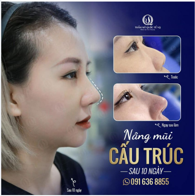 Mũi đẹp chuẩn dáng - sáng ngời mặt xinh
