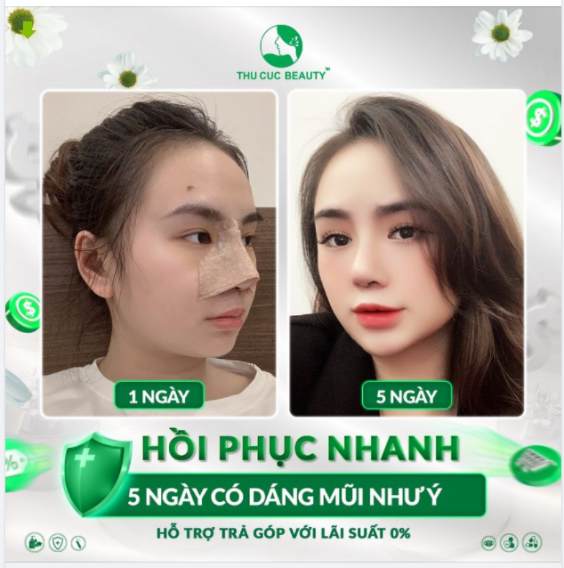 MŨI ĐẸP NHƯ Ý - CHI PHÍ CỰC HỜI