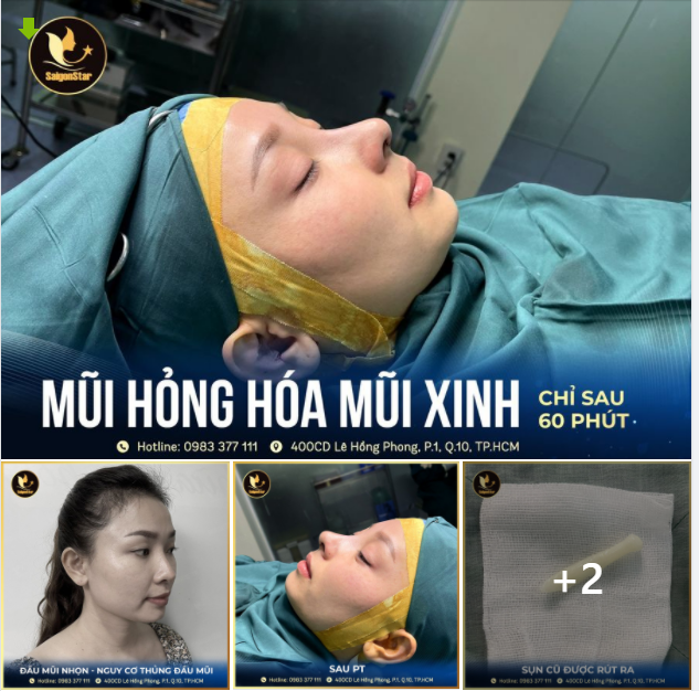MŨI HỎNG HÓA MŨI XINH - LUNG LINH SAU PHẪU THUẬT