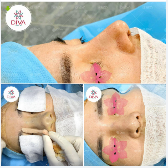 MŨI NÂNG BỊ LỖI - PHƯƠNG PHÁP NÀO SỬA MŨI AN TOÀN?