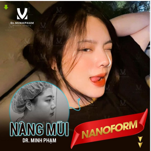 MŨI NANOFORM CỰC XINH – GHI HÌNH CỰC ĐỈNH FEEDBACK KH XINH ĐẸP TỰ TIN SELFIE