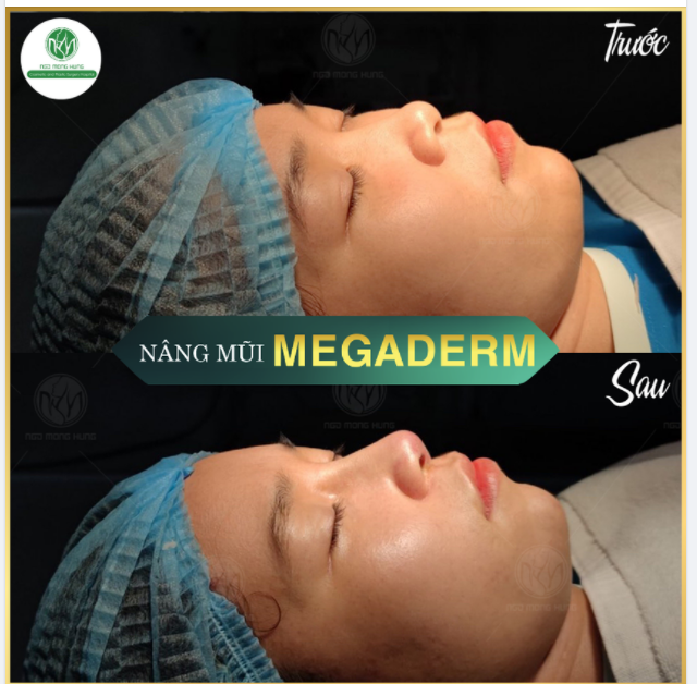 MŨI THẤP KHÔNG NHƯ Ý  "XÓA NGAY" CHỈ SAU 30 PHÚT