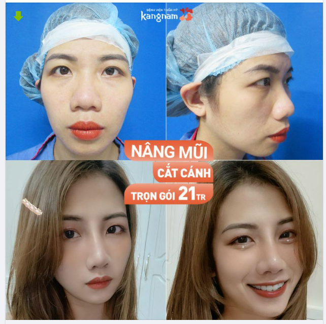 Mũi to, cánh mũi bè? Nâng mũi cắt cánh ngay