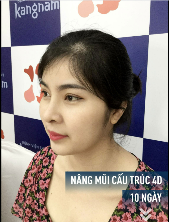 Mũi tự nhiên như này đã ưng chưa ạ