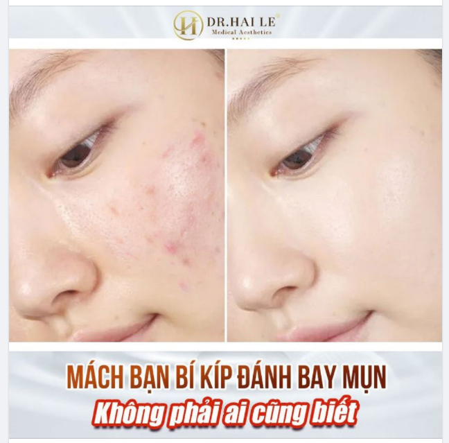 Mụn đầu trắng; mụn đầu đen; mụn nhọt; xuất hiện nốt sần lớn ở dưới bề mặt da.......Hoàn toàn có thể điều trị nếu sử dụng ĐÚNG KỸ THUẬT - ĐÚNG PHƯƠNG PHÁP- ĐỦ LIỆU TRÌNH.
