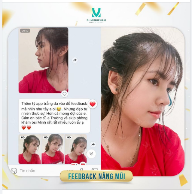 MUỐN MŨI XINH – VỀ NGAY TEAM DR MINH PHẠM FEEDBACK NGƯỜI THẬT VIỆC THẬT