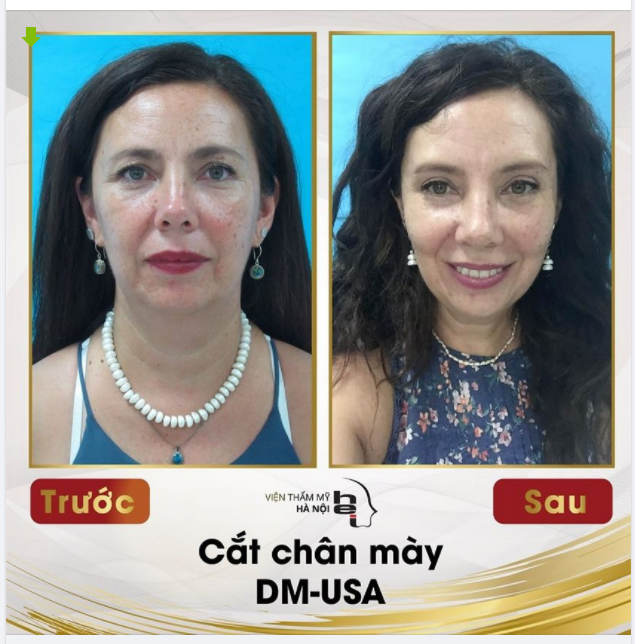 Nâng cung chân mày là tiểu phẫu loại bỏ phần da dư, mỡ thừa trên hoặc dưới chân mày khắc phục hiện tượng sụp mí, làm nếp mí rõ ràng hơn, mắt to tròn, trẻ trung hơn.