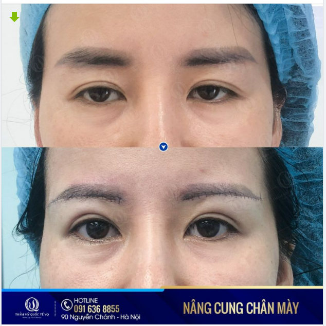 NÂNG CUNG CHÂN MÀY - TRẺ HOÁ TOÀN DIỆN