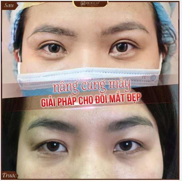 NÂNG CUNG MÀY - GIẢI PHÁP VÀNG CHO ĐÔI MẮT "KHÔNG TUỔI".!!