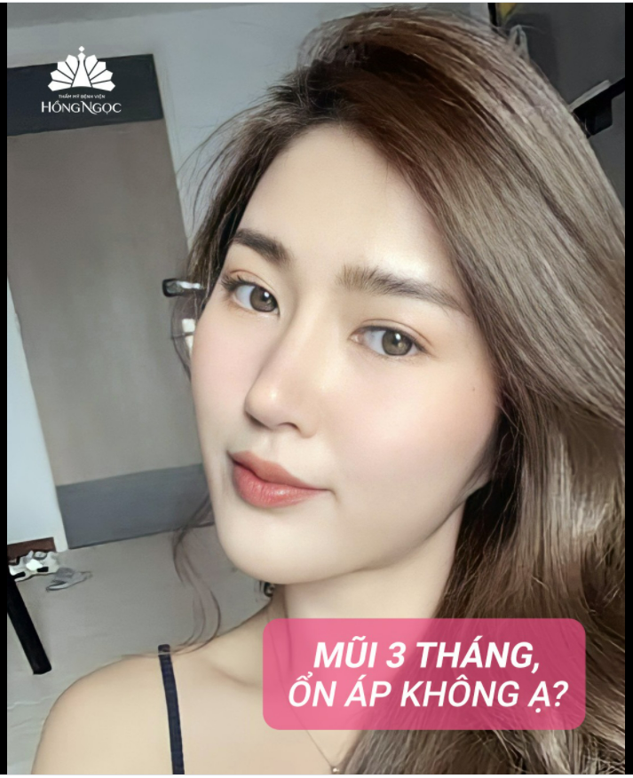 NÂNG MŨI 3 THÁNG ỔN ÁP KHÔNG CẢ NHÀ?