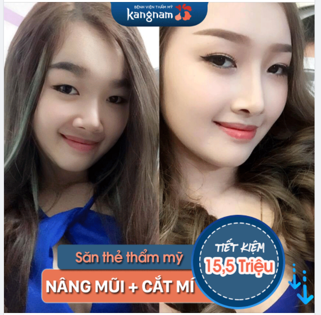 NÂNG MŨI CẮT MÍ Đẹp An toàn - Nhận SIÊU TRỢ GIÁ