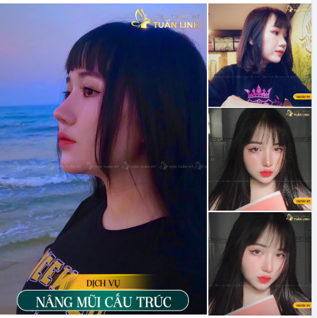 NÂNG MŨI CẤU TRÚC - DÁNG MŨI CAO TÂY CHINH PHỤC MỌI CÔ GÁI.
