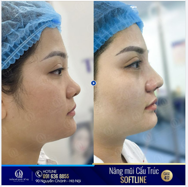 Nâng mũi cấu trúc Softline - Mũi đẹp chuẩn nhân trắc học
