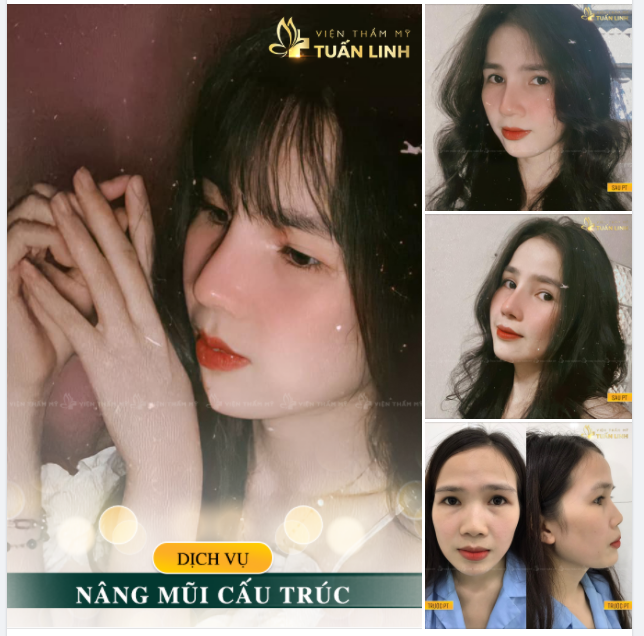 NÂNG MŨI CẤU TRÚC - THAY ĐỔI 90% NHAN SẮC GƯƠNG MẶT - XINH SANG HẾT "NẤC".