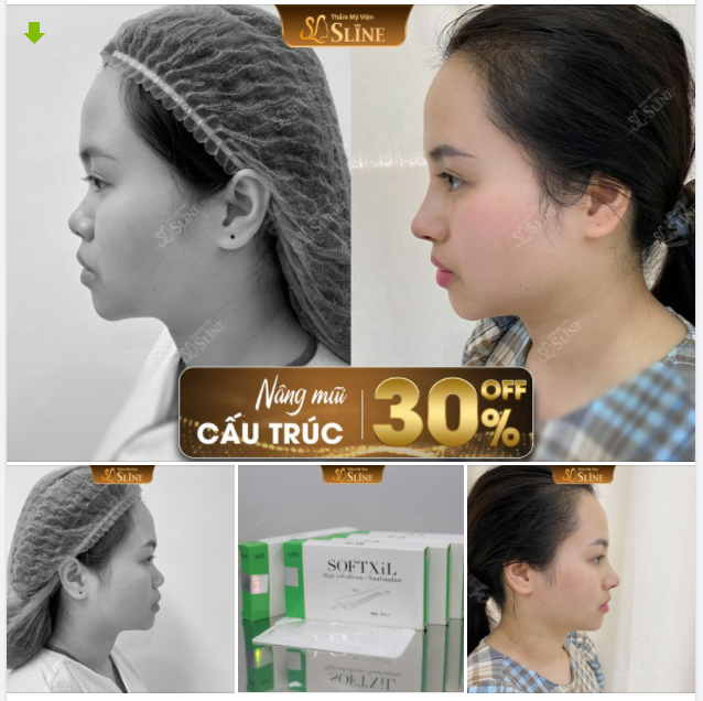 NÂNG MŨI CẤU TRÚC