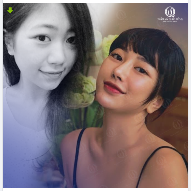 Nâng mũi có lẽ là lựa chọn đúng đắn đắn nhất trong hành trình hoàn thiện nhan sắc của bạn ấy