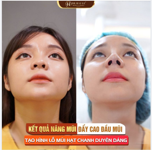NÂNG MŨI, ĐẨY CAO ĐẦU MŨI - Tạo hình lỗ mũi hạt chanh duyên dáng.!