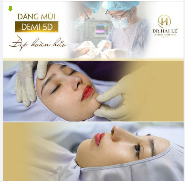 Nâng mũi DEMI 5D 10 người làm 10 người hài lòng