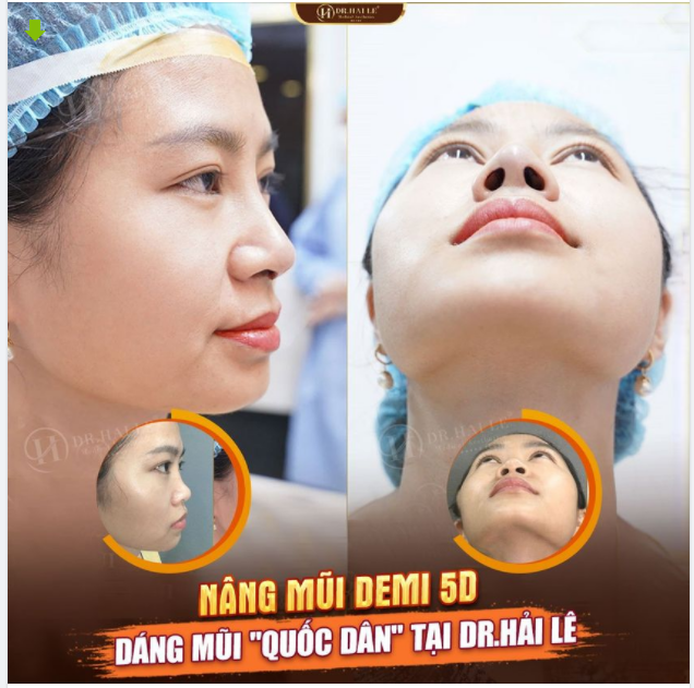 Nâng mũi Demi 5D - dáng mũi "quốc dân" tại Dr.Hải Lê luôn làm hài lòng khách hàng!