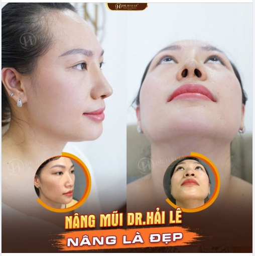 NÂNG MŨI DEMI 5D GIÚP TẠO HÌNH LỖ MŨI HẠT CHANH DUYÊN DÁNG