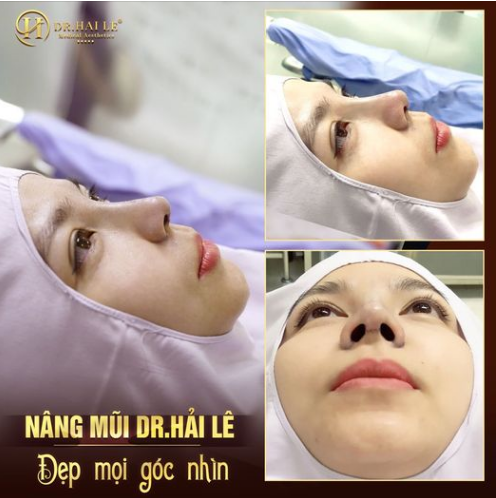 Nâng mũi Demi Tech 6D - Mũi đẹp chuẩn HOTGIRL